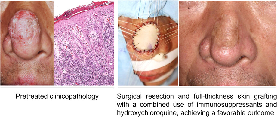 A case of refractory hypertrophic lupus erythematosus on the face whose irreversible skin fibrosis was treated by local full-thickness skin graft under disease control with a combined use of topical and systemic immunosuppressants, and hydroxychloroquine