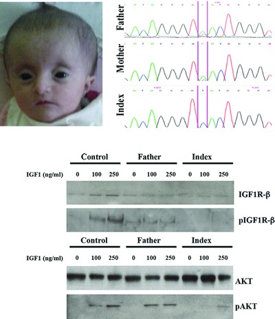 A New Homozygous IGF1R Variant Defines a Clinically Recognizable Incomplete Dominant form of SHORT Syndrome