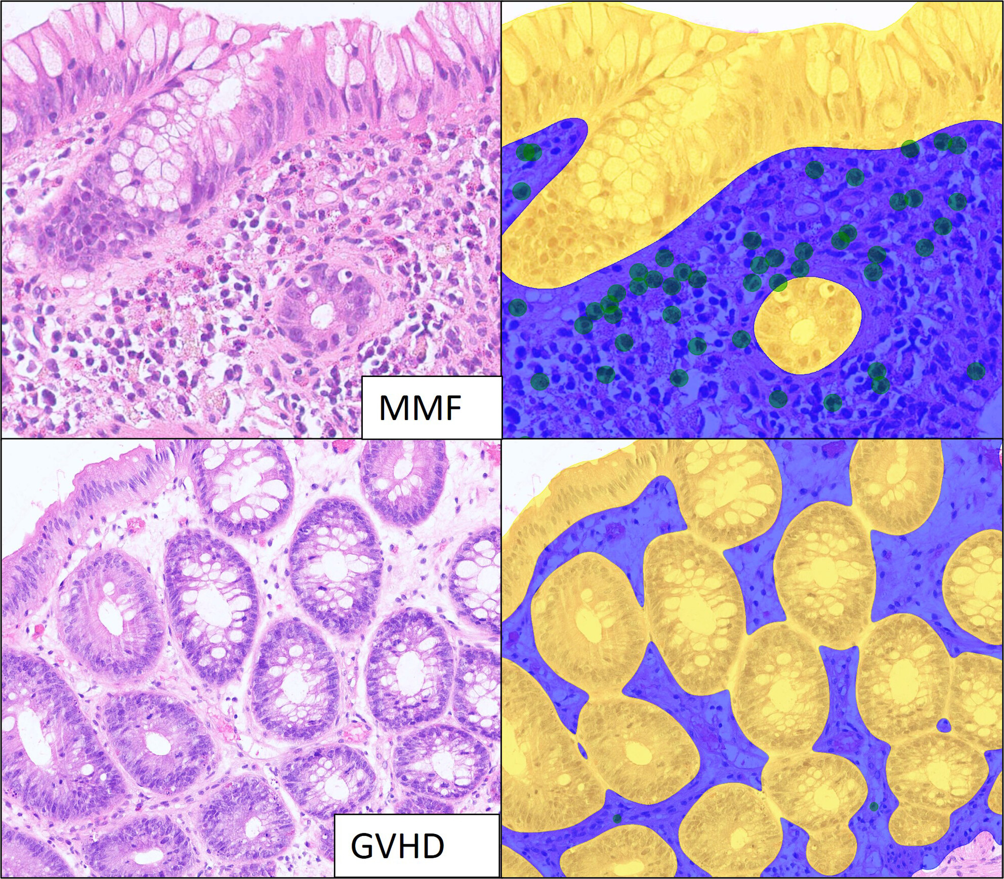 Mycophenolate mofetil-induced colitis versus colonic graft-versus-host disease: a comparative histologic study with artificial intelligence model development