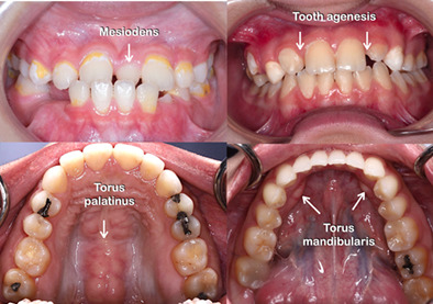 Mutations in LRP5 and BMP4 are associated with mesiodens, tooth agenesis, root malformation, and oral exostoses