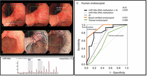 Combination of artificial intelligence-based endoscopy and miR148a methylation for gastric indefinite dysplasia diagnosis
