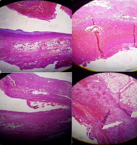 Abdominal pain in the patient with antiphospholipid antibody syndrome: A case report