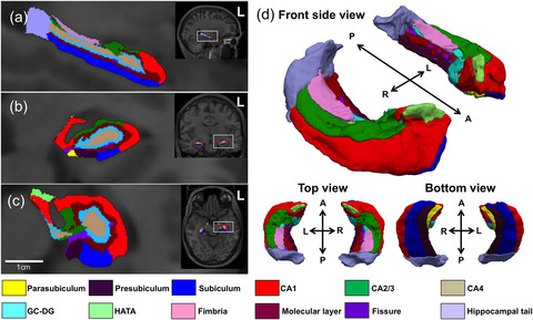 Analysis of human hippocampal volumetry in relation to pattern separation ability in healthy young subjects
