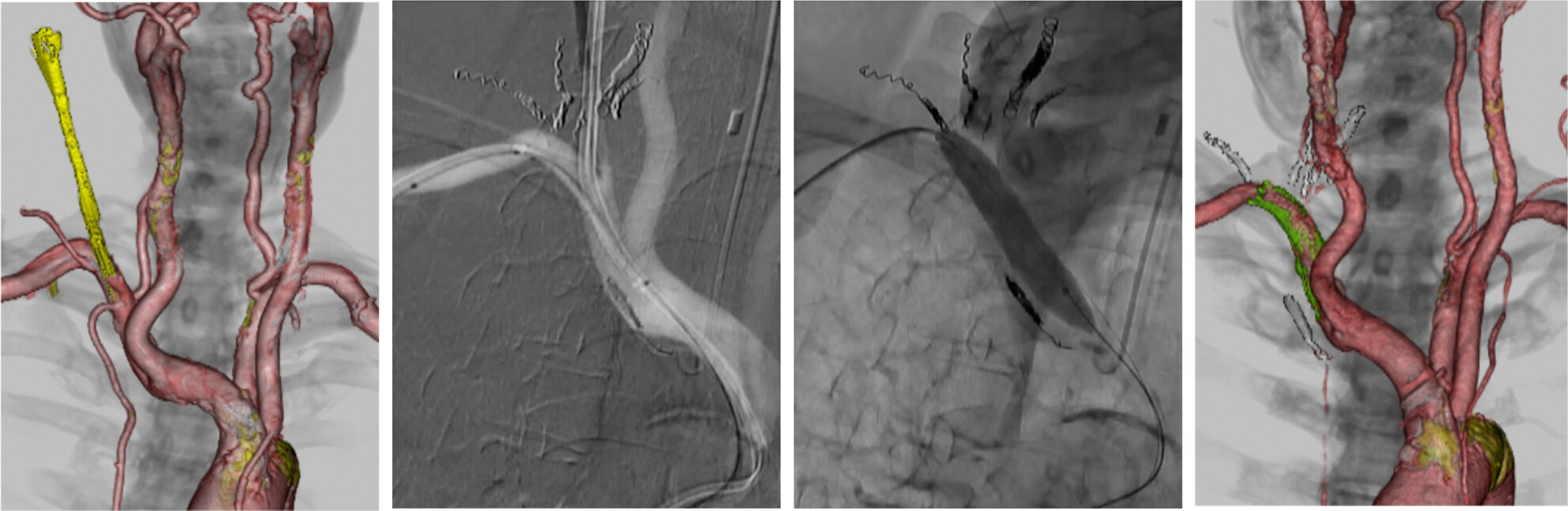 Inadvertent insertion of dialysis catheter into subclavian artery treated with a covered stent: A case report