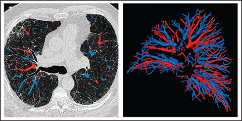 Quantitative CT-derived vessel metrics in idiopathic pulmonary fibrosis: A structure–function study