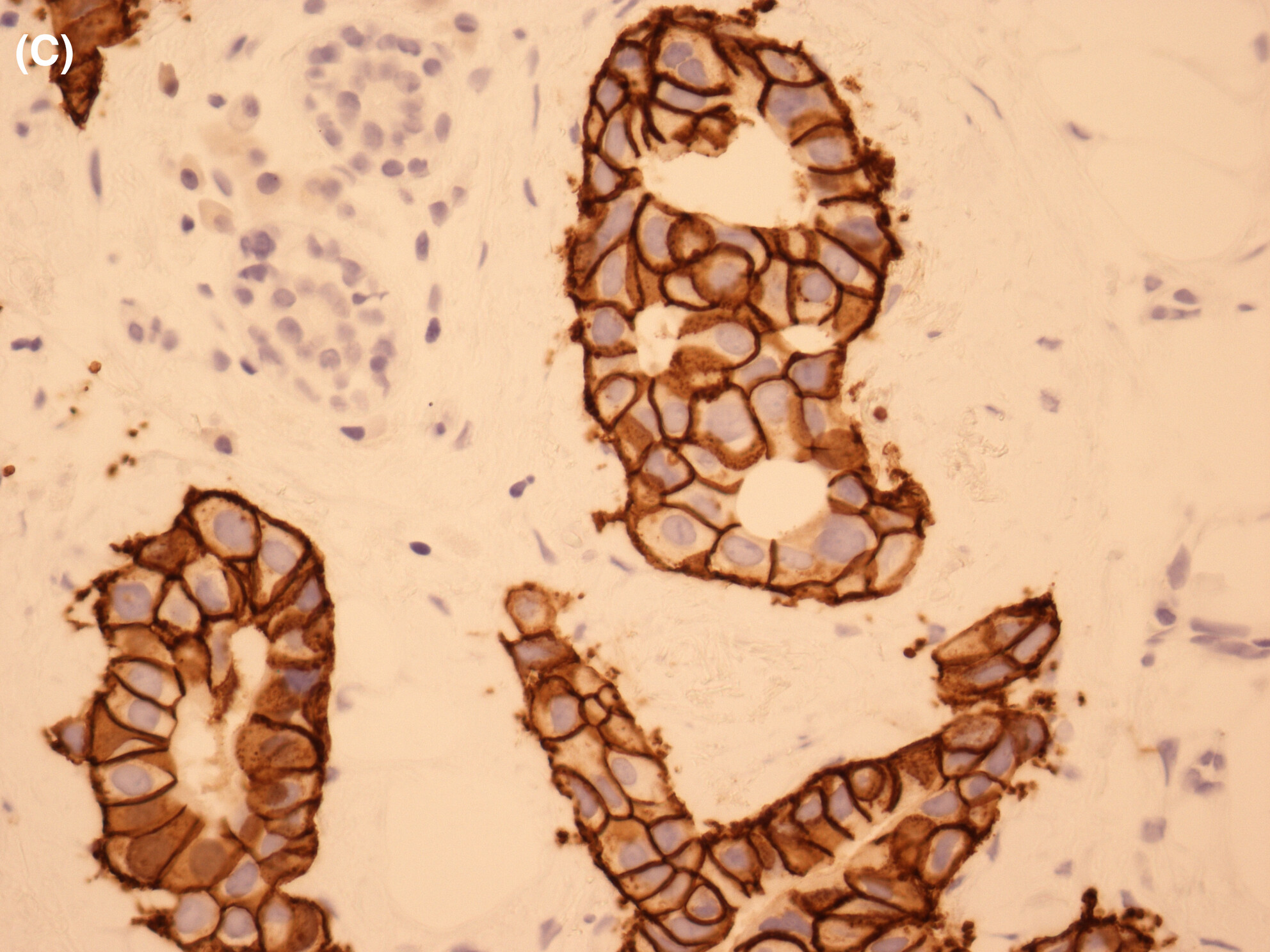 HER2-positive grade 1 invasive carcinomas of the breast