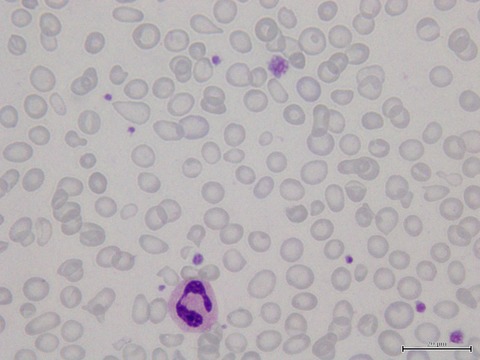 Iron deficiency anemia due to excessive green tea drinking Issue 11, 2016