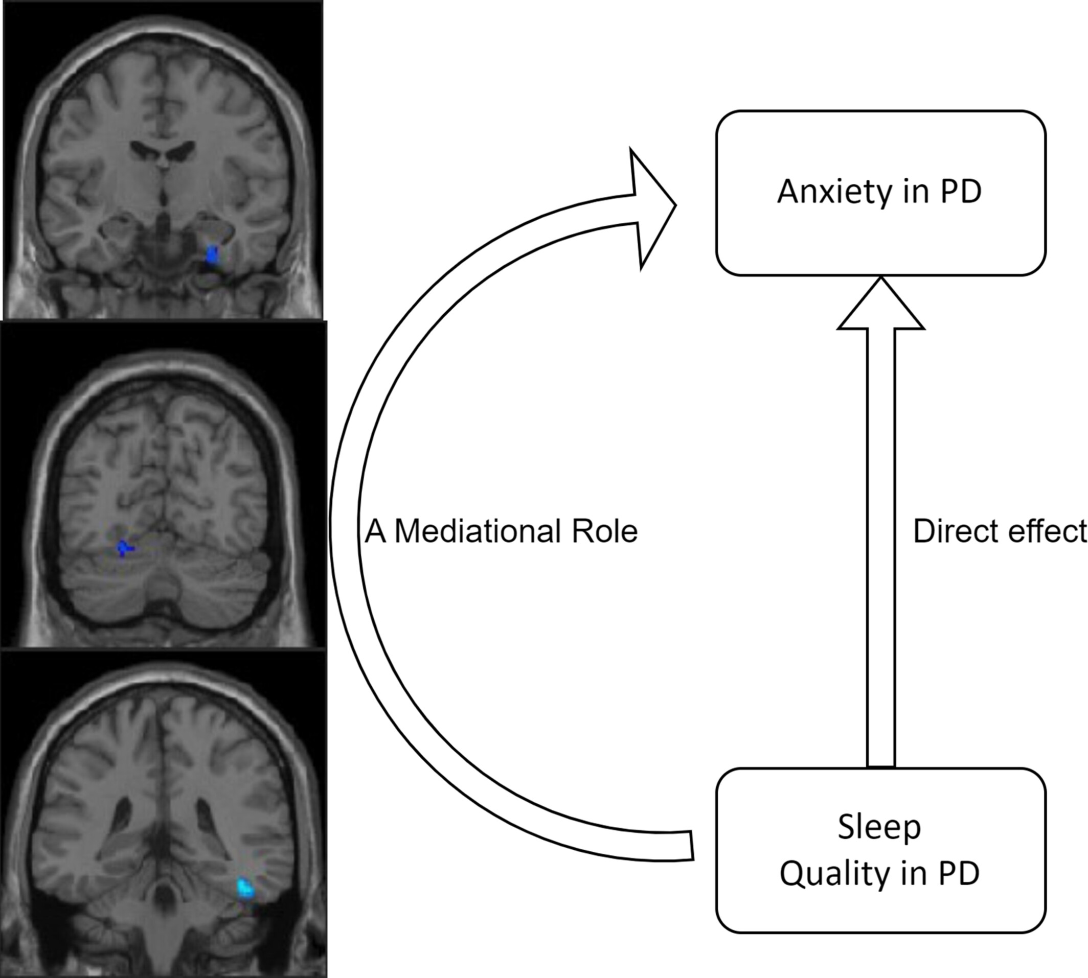 Gray matter volume alterations in de novo Parkinson's disease: A mediational role in the interplay between sleep quality and anxiety