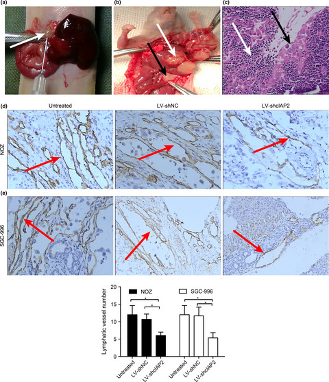 cIAP2 promotes gallbladder cancer invasion and lymphangiogenesis by activating the NF-κB pathway