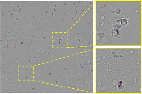 Pathological crystal imaging with single-shot computational polarized light microscopy