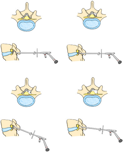 Full-Endoscopic Foraminotomy with a Novel Large Endoscopic Trephine for Severe Degenerative Lumbar Foraminal Stenosis at L5S1 Level: An Advanced Surgical Technique