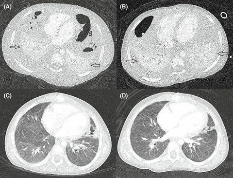 Necrotizing pneumonia requiring prolonged extracorporeal membrane oxygenation: Pushing the boundaries in pediatric ECMO