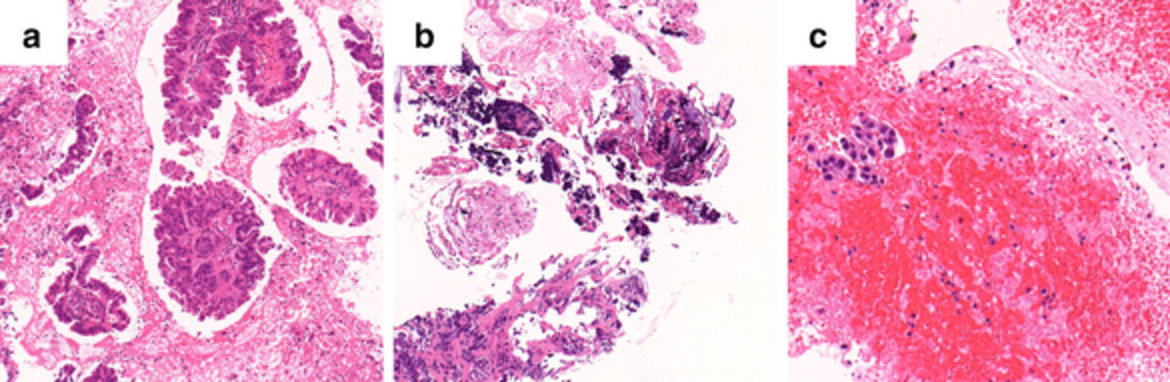Comparison of adequacy between transbronchial lung cryobiopsy samples and endobronchial ultrasound-guided transbronchial needle aspiration samples for next-generation sequencing analysis