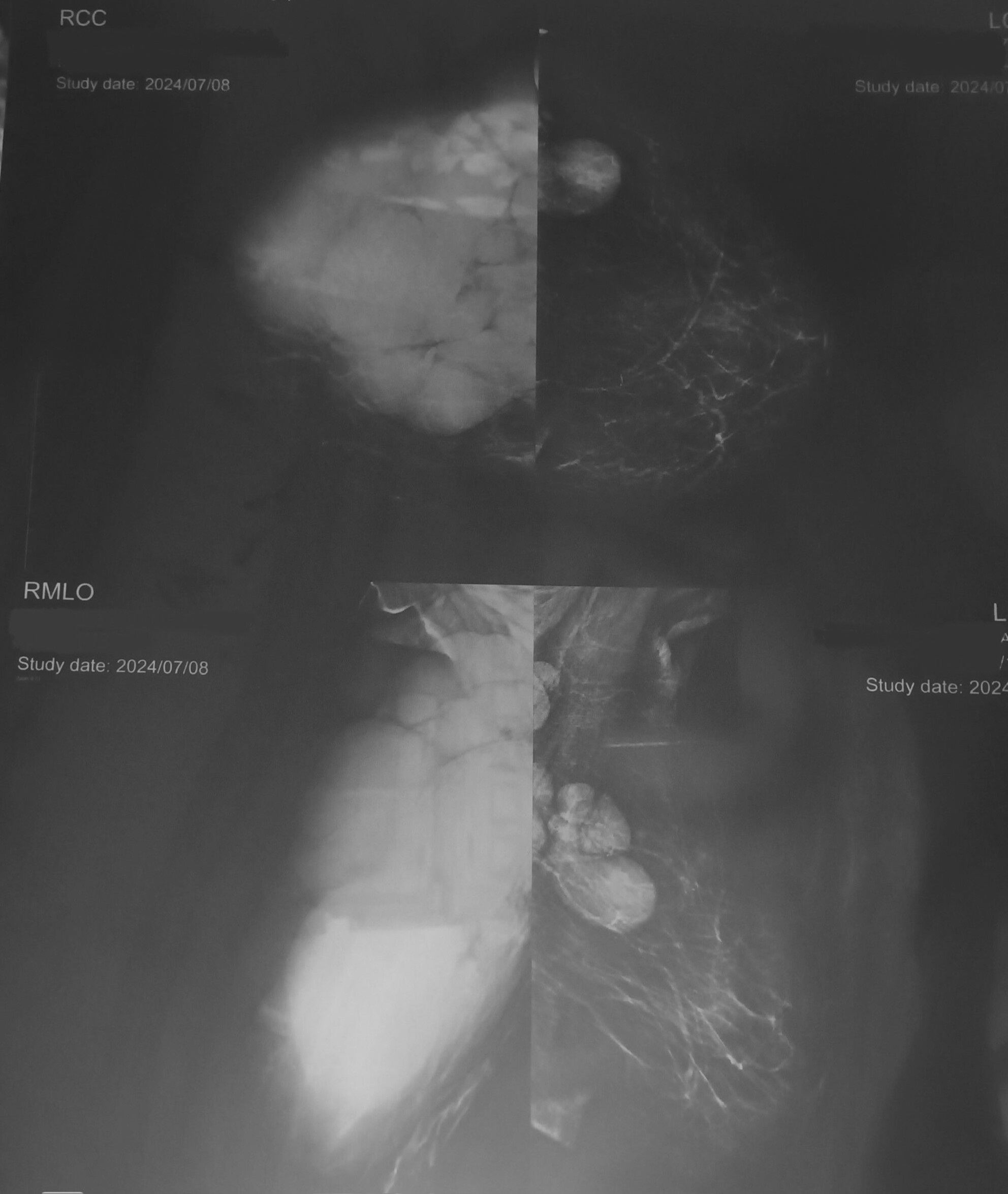 Extranodal Manifestation of Chronic Lymphocytic Leukemia: A Case of Bilateral Breast Involvement