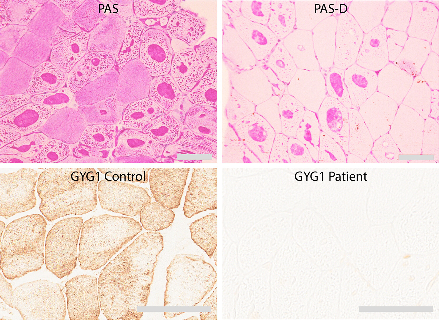 Proteomic profiling of polyglucosan bodies associated with glycogenin-1 deficiency in skeletal muscle