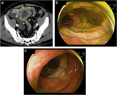 A rare cause of jejunal perforation: Monomorphic epitheliotropic intestinal T-cell lymphoma