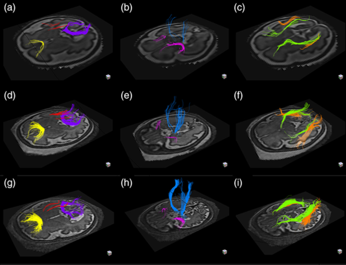 In vivo characterization of emerging white matter microstructure in the fetal brain in the third trimester
