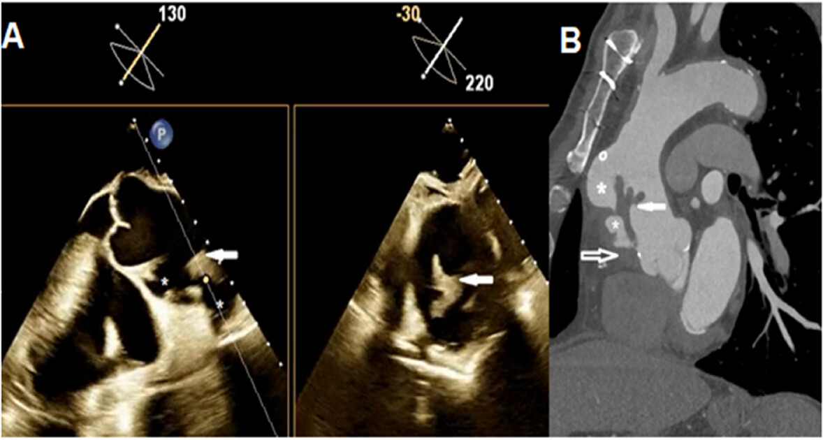 Pseudoaneurysms of the Ascending Aorta Following Coronary Artery Bypass Surgery, Presenting as Stroke