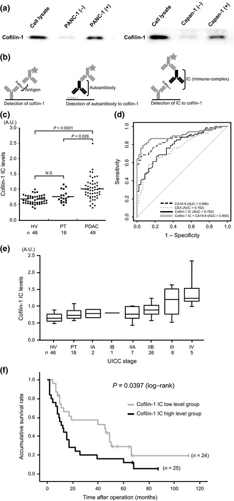 Immune-complex level of cofilin-1 in sera is associated with cancer progression and poor prognosis in pancreatic cancer