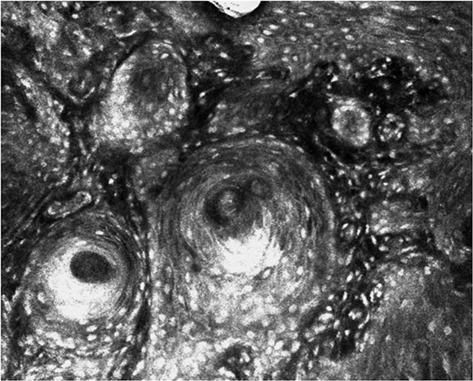Ex vivo confocal microscopy features of cutaneous squamous cell carcinoma