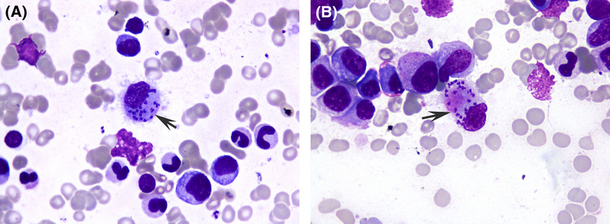 Leishmania donovani bodies in bone marrow