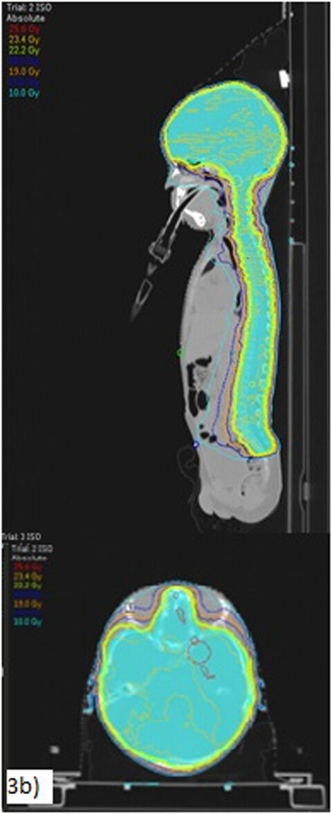 Modified volumetric modulated arc therapy technique with reduced planning and treatment time for craniospinal irradiation utilising two isocentres