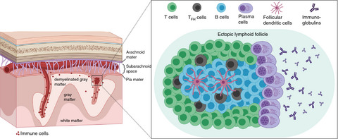 Ectopic lymphoid follicles in progressive multiple sclerosis: From patients to animal models