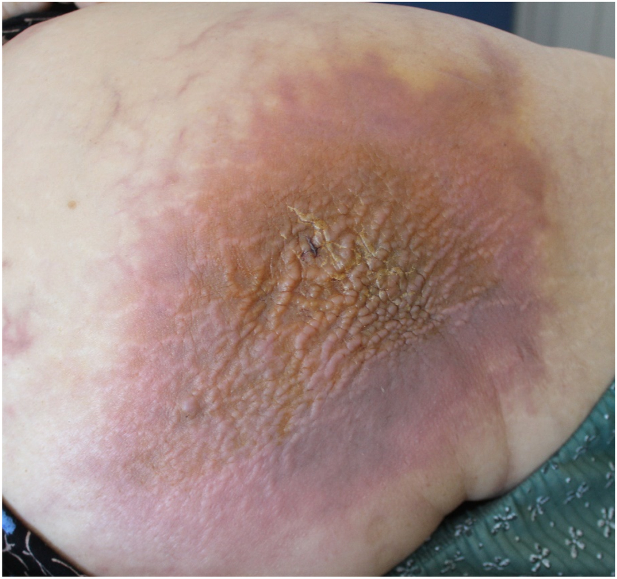 A rare case of melanoma erysipeloides