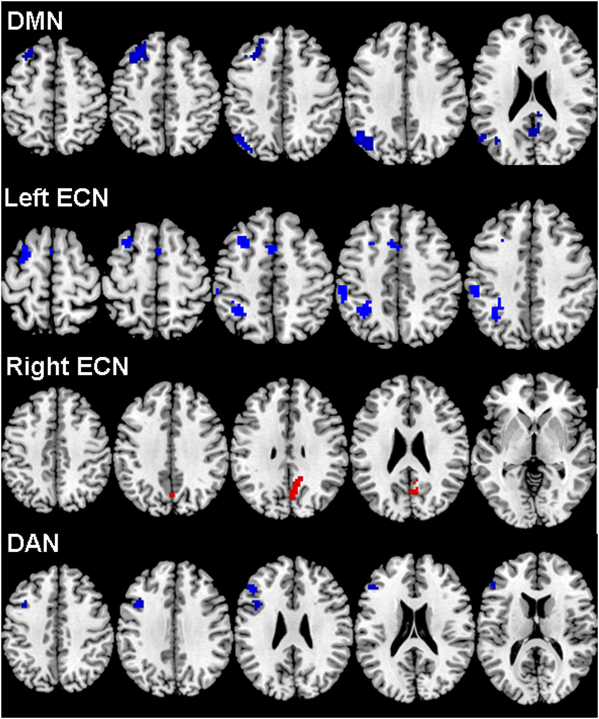 Altered Cognitive Networks Connectivity in Parkinson's Disease During the Microlesion Period After Deep Brain Stimulation