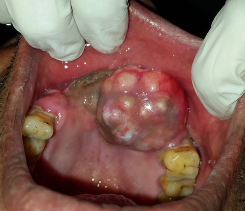 Chondroblastic osteosarcoma—A case report and review of literature