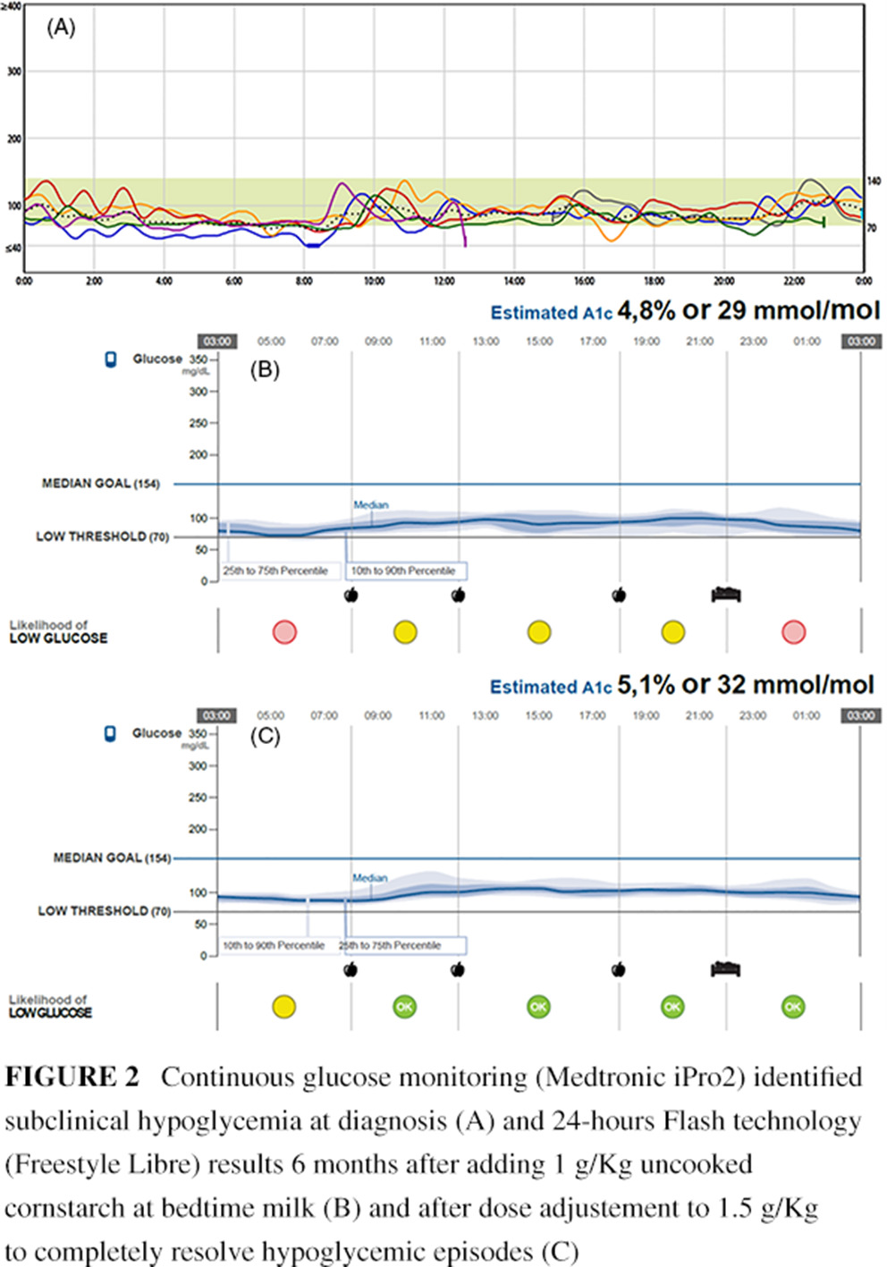 A novel heterozygous mutation in the SLC5A2 gene causing severe glycosuria, mild failure to thrive, and subclinical hypoglycemia 一种新的SLC5A2基因杂合突变导致严重的糖尿、轻度的生长障碍和亚临床低血糖
