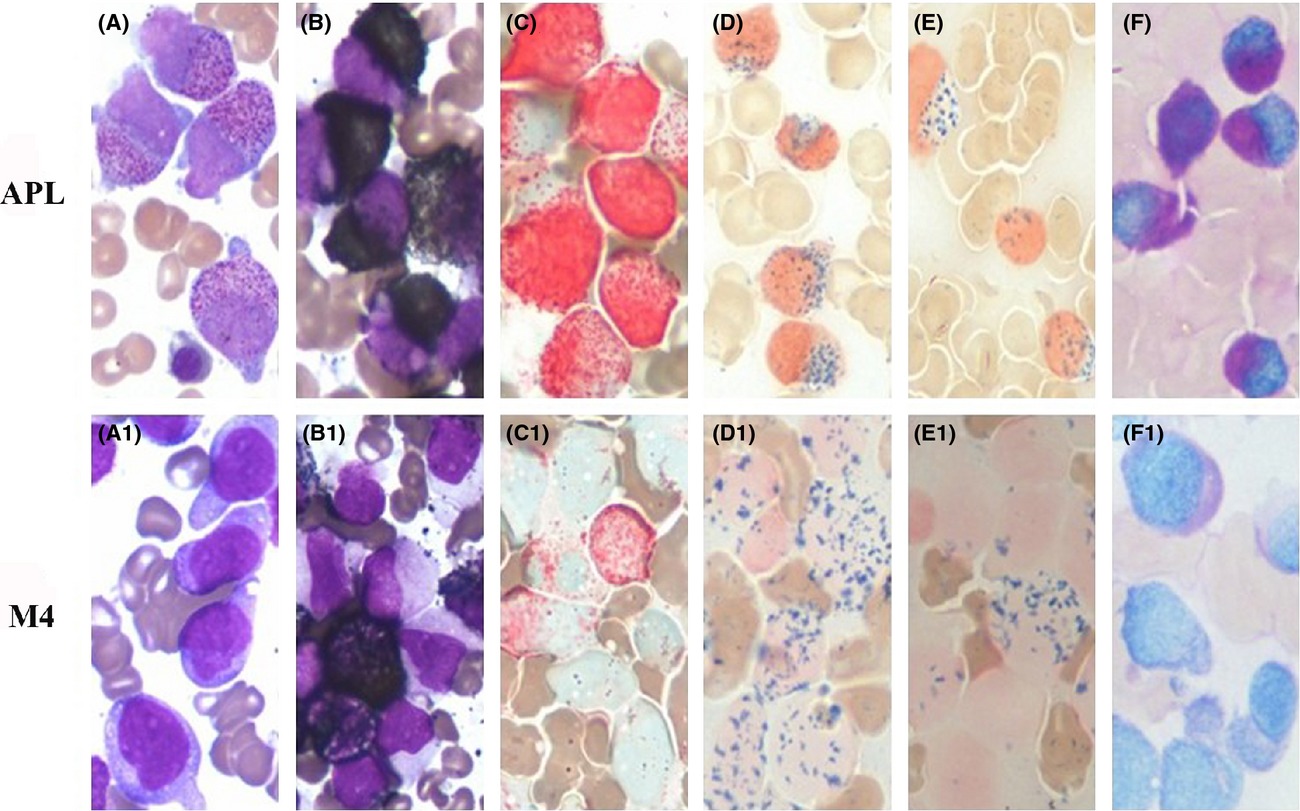 MLL-ELL fusion gene in an acute myelomonocytic leukemia patient transformed from acute promyelocytic leukemia