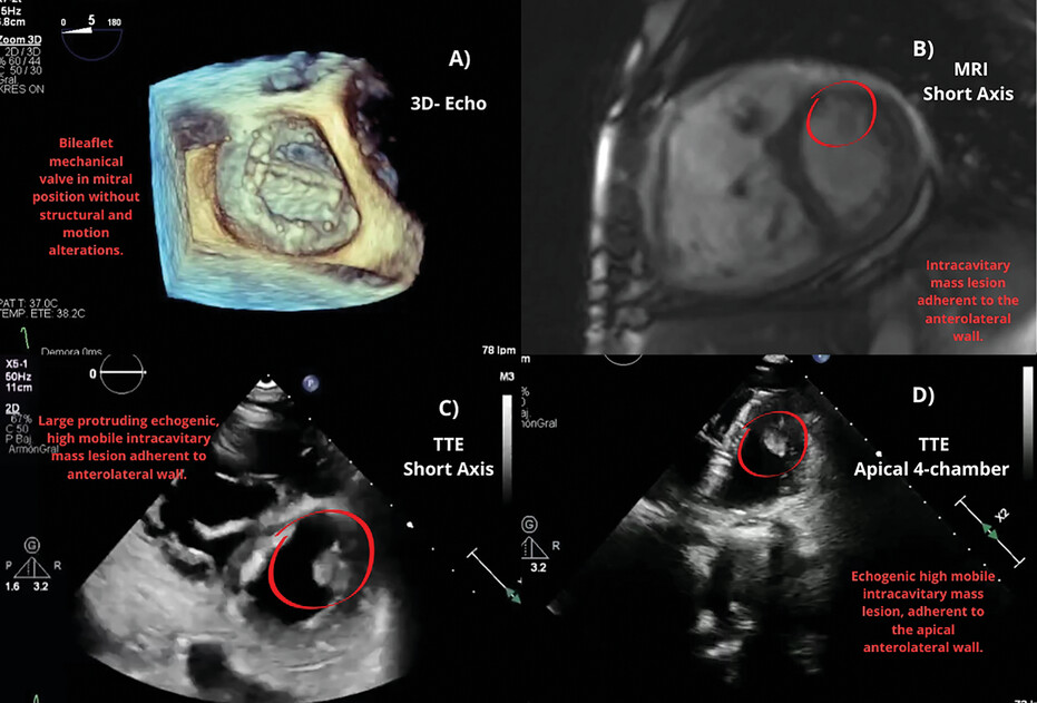 Multimodality Imaging Approach for a Transient Ischemic Stroke as a First Manifestation of Papillary Fibroelastoma