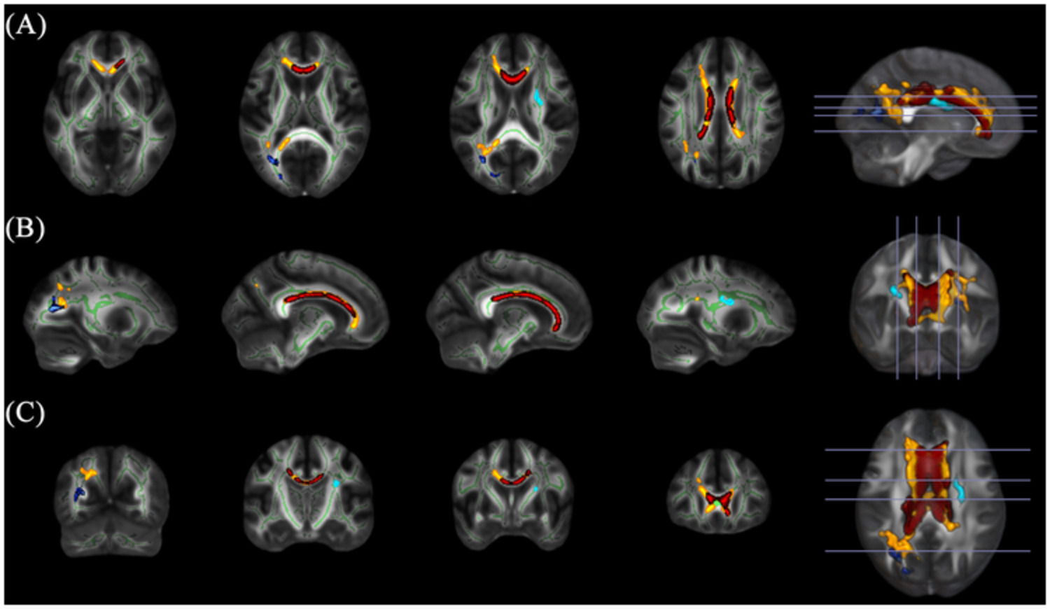 Alterations in white matter microstructure in alcohol and alcohol-polydrug dependence: Associations with lifetime alcohol and nicotine exposure