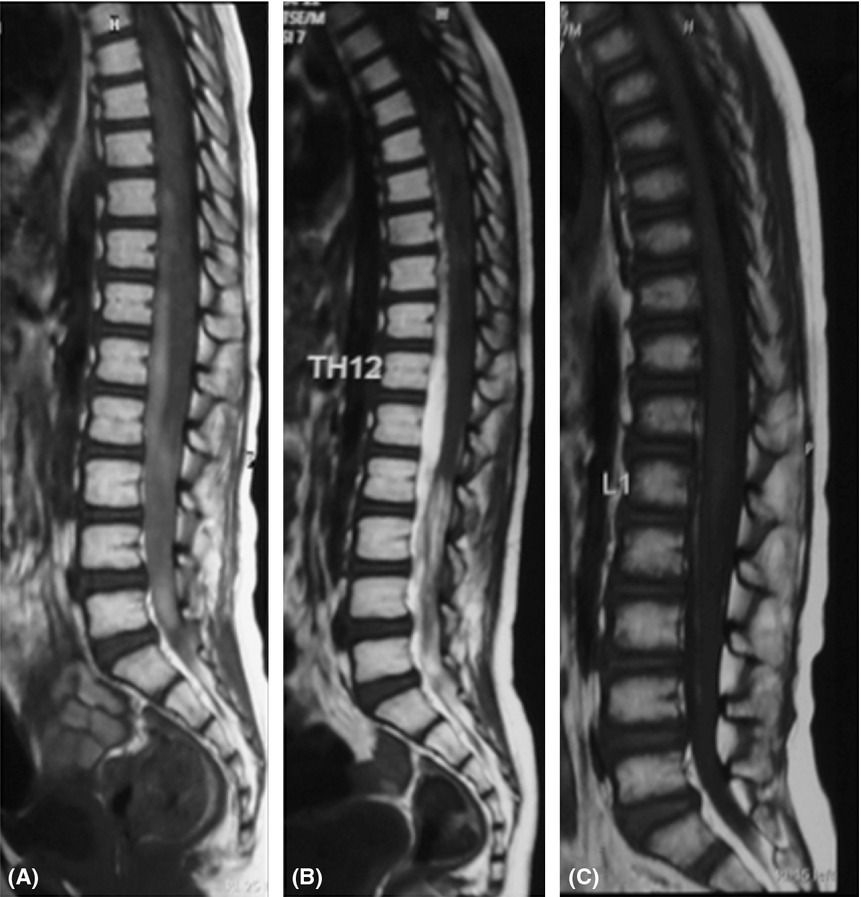 Lumbar puncture complicated by spinal epidural hematoma in a child with leukemia