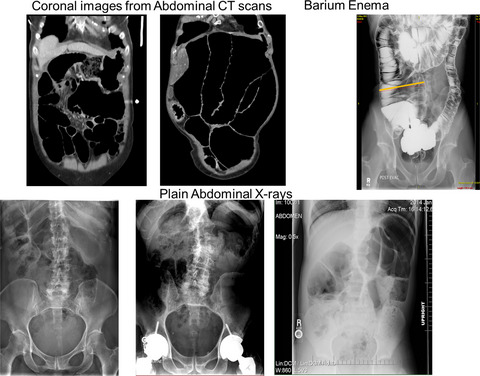 Familial chronic megacolon presenting in childhood or adulthood: Seeking the presumed gene association