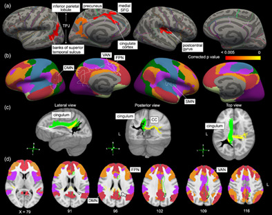 Turning and multitask gait unmask gait disturbance in mild-to-moderate multiple sclerosis: Underlying specific cortical thinning and connecting fibers damage