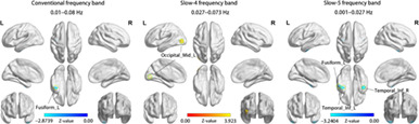 Abnormal amygdala functional connectivity and deep learning classification in multifrequency bands in autism spectrum disorder: A multisite functional magnetic resonance imaging study