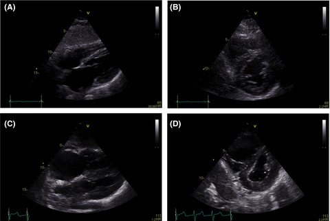 Fatal right-sided heart failure due to leukostasis in a patient with leukemic transformation of myelodysplastic syndrome