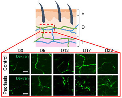 An optical system for noninvasive microscopy of psoriatic mice in vivo