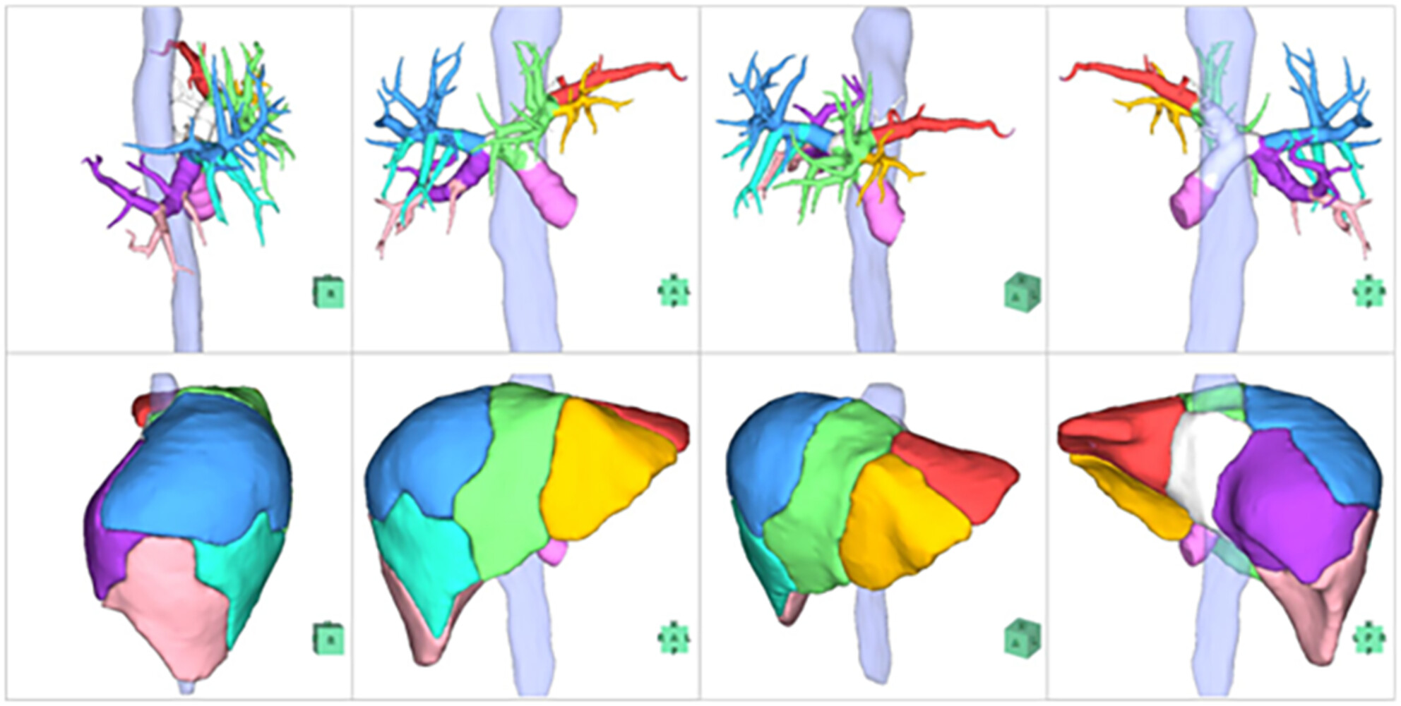 Two-step artificial intelligence algorithm for liver segmentation automates anatomic virtual hepatectomy