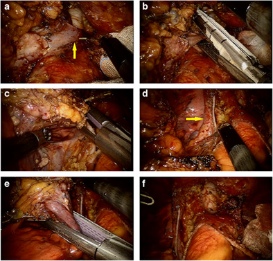 Robot-assisted thymectomy in large anterior mediastinal tumors: A comparative study with video-assisted thymectomy and open surgery