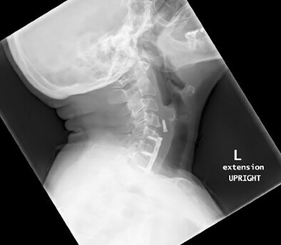 Single-Port Robotic Removal of a Submucosal Foreign Body in the Distal Hypopharynx