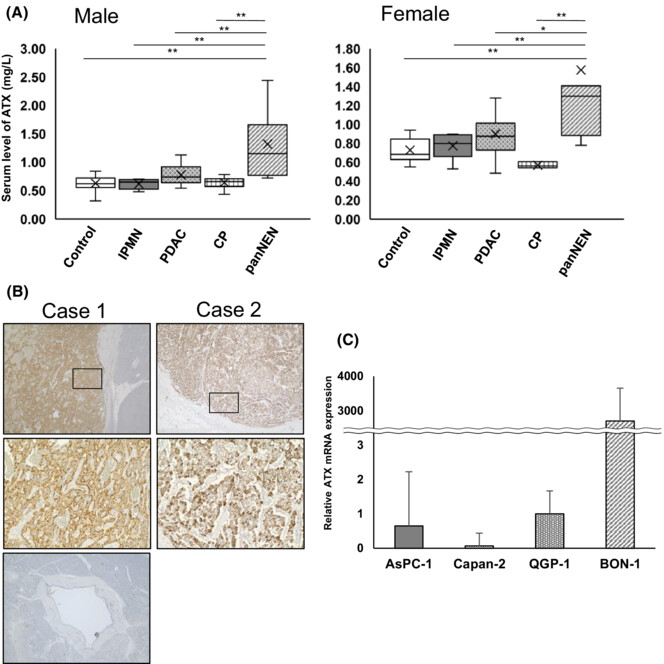 Dual role of autotaxin as novel biomarker and therapeutic target in pancreatic neuroendocrine neoplasms