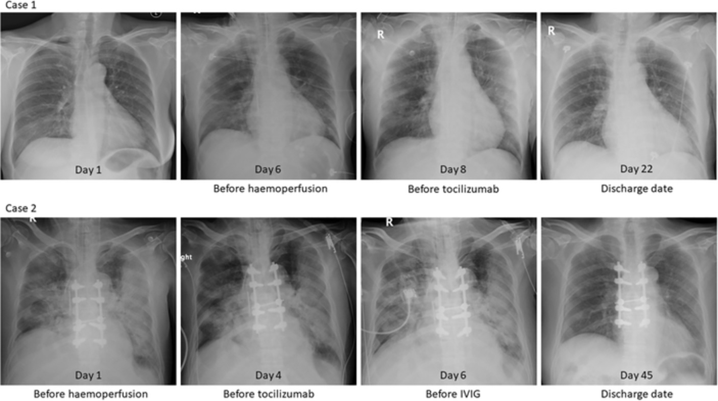 Multimodality treatment in immunocompromised patients with severe COVID-19: the role of IL-6 inhibitor, intravenous immunoglobulin, and haemoperfusion