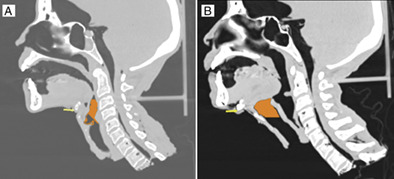 Hyoid expansion with titanium plate and screws with hyomandibular suspension: A study on human cadavers with computed tomographic comparative analysis