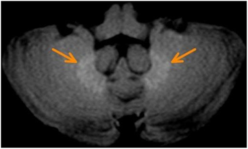 High signal intensity in dentate nucleus and globus pallidus on unenhanced T1-weighted MR images in three patients with impaired renal function and vascular calcification