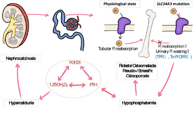 Clinical Spectrum of Hereditary Hypophosphatemic Rickets With Hypercalciuria (HHRH)
