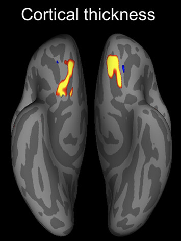 Lifelong olfactory deprivation-dependent cortical reorganization restricted to orbitofrontal cortex