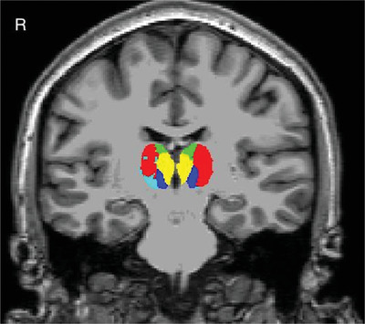 Reexperiencing and anxious arousal symptoms in relation to volumes of thalamus nuclei in posttraumatic stress spectrum adults